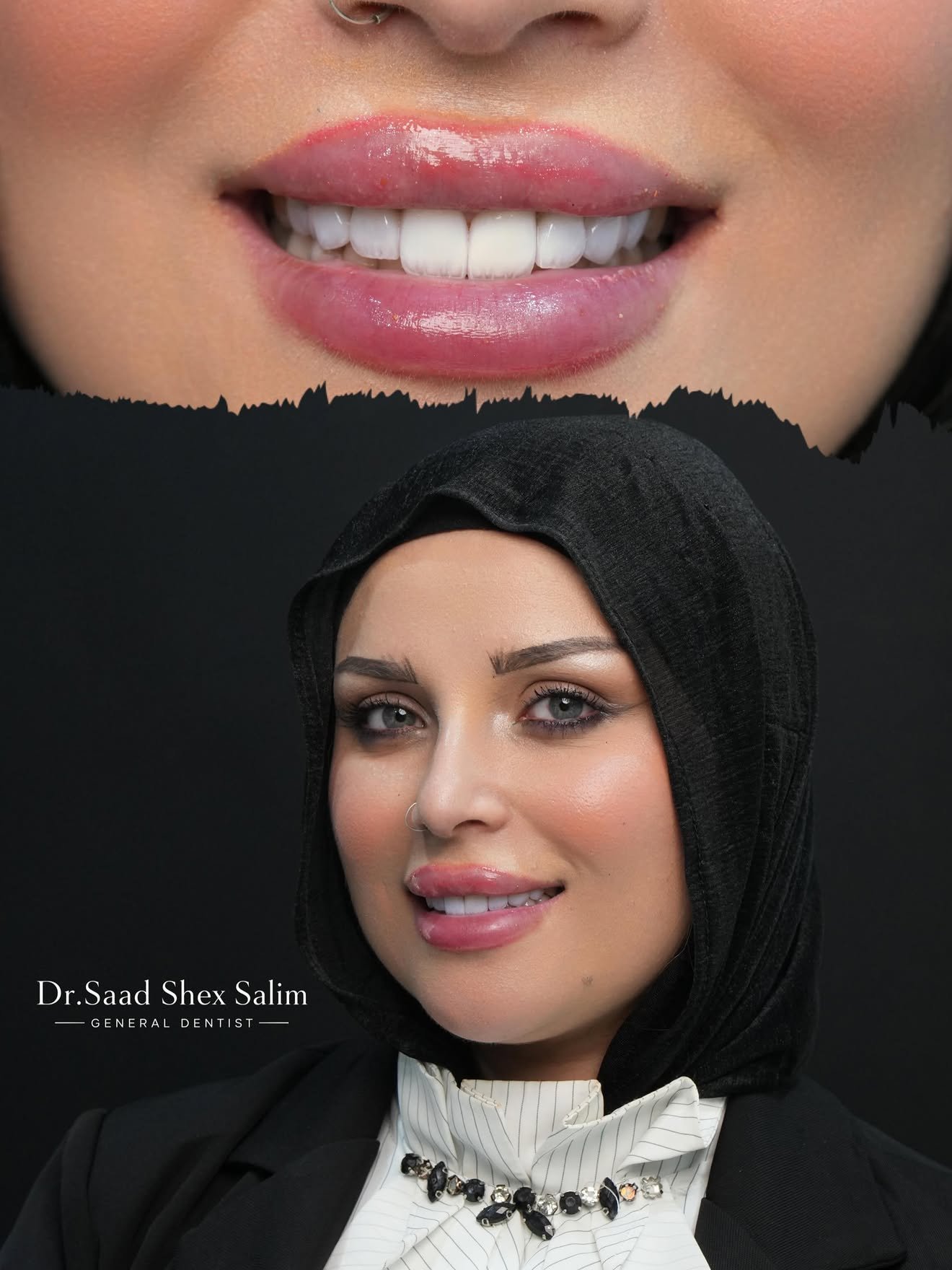 Veneers result