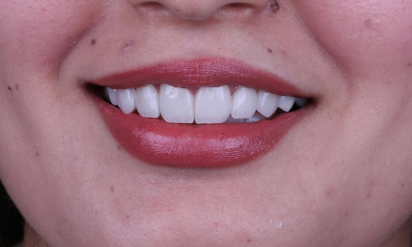 After smile makeover