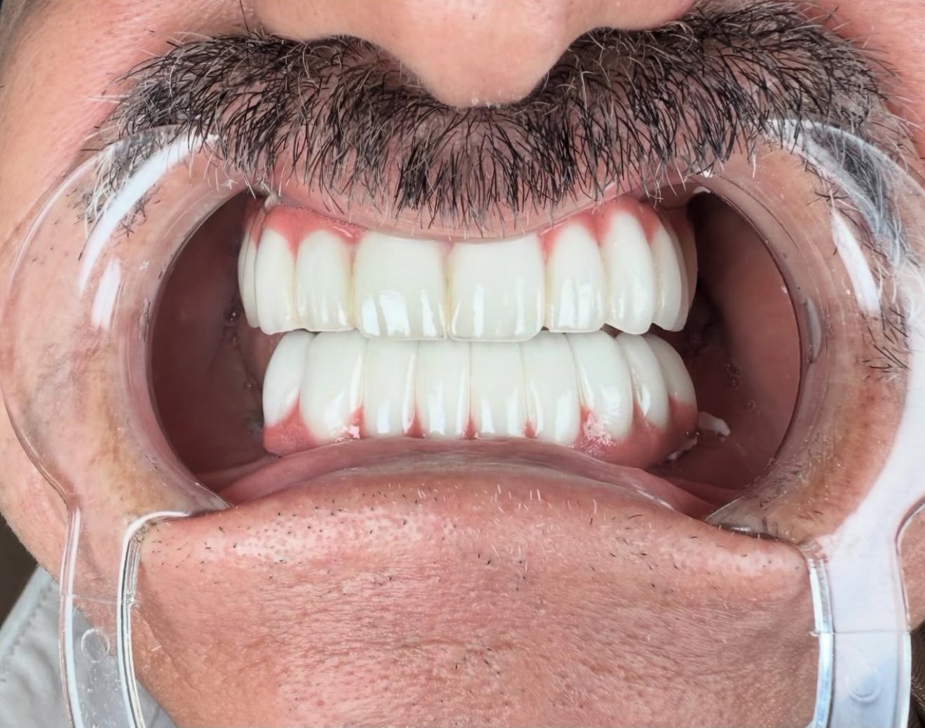 After veneers